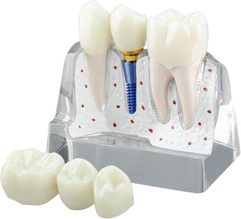 Dental Implant Model for Patient Education, 4 Times Dental Implant, Crown and Bridge Model for Presentation-Pink in Saudi Arabia