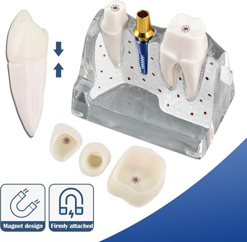 Dental Implant Model for Patient Education, 4 Times Dental Implant, Crown and Bridge Model for Presentation-Pink in Saudi Arabia