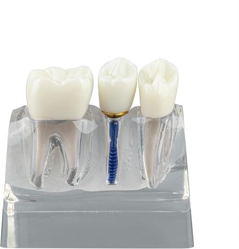 Dental Implant Model for Patient Education, 4 Times Dental Implant, Crown and Bridge Model for Presentation-Pink in Saudi Arabia