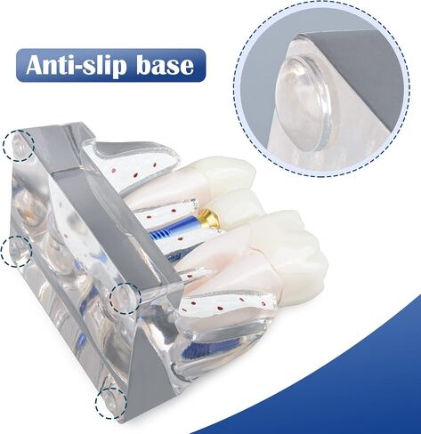 Dental Implant Model for Patient Education, 4 Times Dental Implant, Crown and Bridge Model for Presentation-Pink in Saudi Arabia