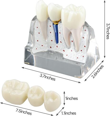 Dental Implant Model for Patient Education, 4 Times Dental Implant, Crown and Bridge Model for Presentation-Pink in Saudi Arabia