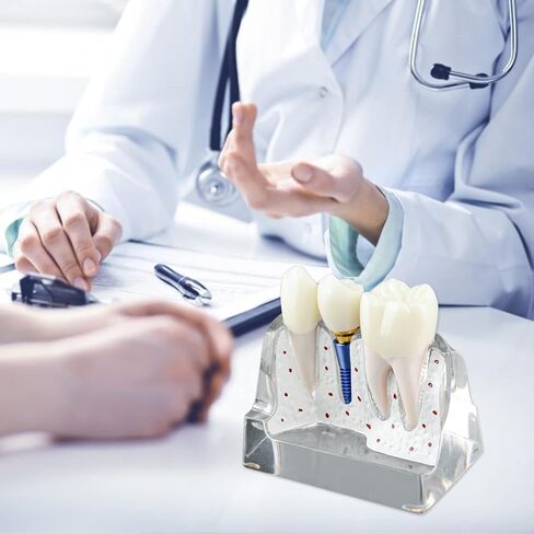 Dental Implant Model for Patient Education, 4 Times Dental Implant, Crown and Bridge Model for Presentation-Pink in Saudi Arabia