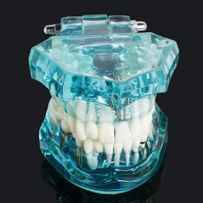 Dental Typodont Implant Restoration Model Dental Pathology Teaching Demonstration Simulation Model (Transparent Blue)