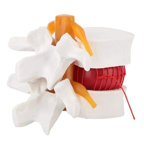 Oumefar 1:1.5 Medical Teaching Demonstration Model of Lumbar Vertebral Spine Vertebrae Degenerative Human Spine Sold Anatomy Lumbar Disc Herniation Model