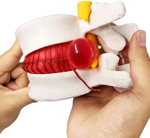 Human Herniated Disc Model, Anatomical Herniated Lumbar Vertebrae Disc Prolapse Model for Medical Teaching Learning, Kids Learning Education Display Toolning, Kids Learning Education Display Tool in Kuwait