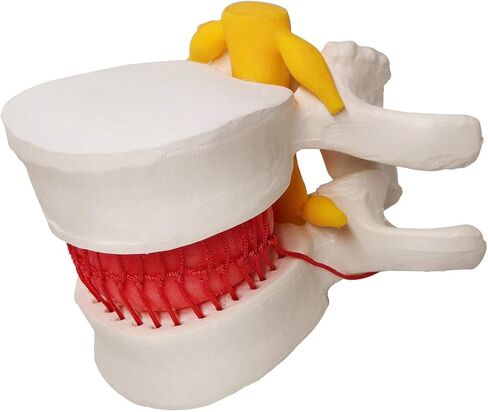 Human Herniated Disc Model, Anatomical Herniated Lumbar Vertebrae Disc Prolapse Model for Medical Teaching Learning, Kids Learning Education Display Toolning, Kids Learning Education Display Tool in Kuwait