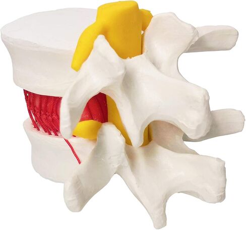 Human Herniated Disc Model, Anatomical Herniated Lumbar Vertebrae Disc Prolapse Model for Medical Teaching Learning, Kids Learning Education Display Toolning, Kids Learning Education Display Tool in Kuwait