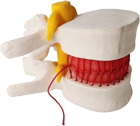 Human Herniated Disc Model, Anatomical Herniated Lumbar Vertebrae Disc Prolapse Model for Medical Teaching Learning, Kids Learning Education Display Toolning, Kids Learning Education Display Tool in Kuwait