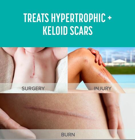 Burn Scar Pro™ Silicone Scar Sheets with Sunscreen – Fade Burn Scars, Keloids, and Scars from Surgery – Reusable Patches for Skin Burns, Facial Scars, and Healed Wounds – 6" x 3.5" (2 Sheets) in Saudi Arabia