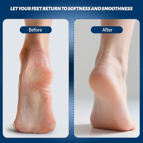 Electric Feet Foot Callus Remover Equipped with A Vacuum System Foot Scrubber 17 in 1 Professional Foot Care Tool Ipx6 Waterproof Rating for Removing Hard Cracks Dryness and Dead Skin (Black) in Kuwait