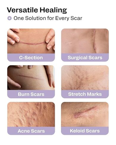 AWD Silicone Scar Sheets for Surgical Scars - Seamless Medical Grade Silicone Scar Tape for C Section, Tummy Tuck Tape - Silicone Skin Patches After Surgery Must Haves (1.6" x 60" Seamless Roll) in Kuwait
