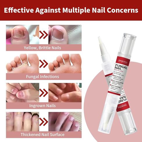 Toenail Fungus Treatment Extra Strength Nail Repair Pen, Repair Damaged Nails Yellow, Discolored, Thick and Ingrown Nails, Fungus Pen for Toenails and Fingernails with Tea Tree Oil, 3 Pens & 3 Files in Saudi Arabia