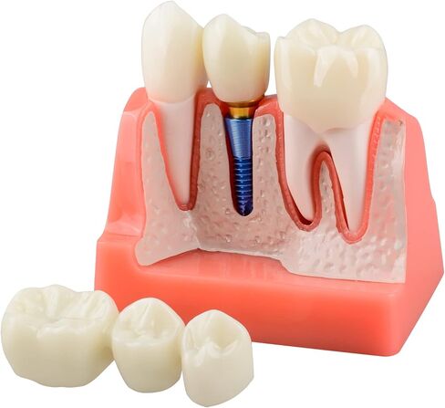 Dental Implant Model for Patient Education, 4 Times Dental Implant, Crown and Bridge Model for Presentation-Transparent in Saudi Arabia