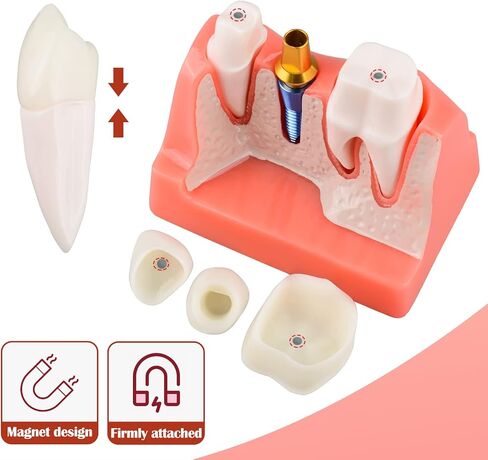Dental Implant Model for Patient Education, 4 Times Dental Implant, Crown and Bridge Model for Presentation-Transparent in Saudi Arabia