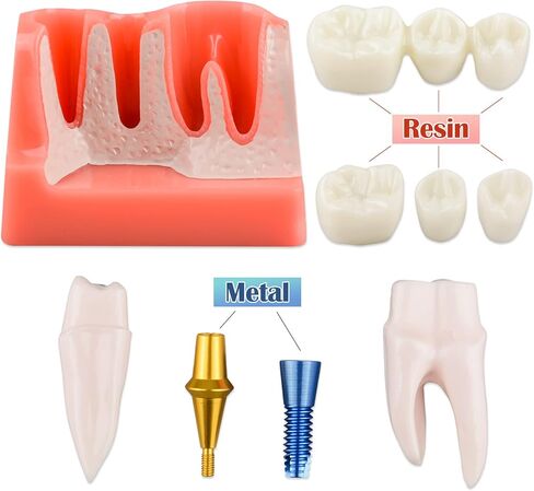 Dental Implant Model for Patient Education, 4 Times Dental Implant, Crown and Bridge Model for Presentation-Transparent in Saudi Arabia