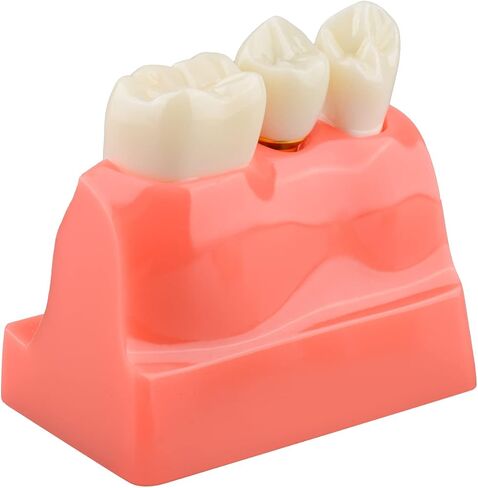 Dental Implant Model for Patient Education, 4 Times Dental Implant, Crown and Bridge Model for Presentation-Transparent in Saudi Arabia