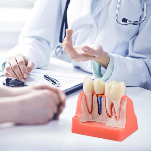 Dental Implant Model for Patient Education, 4 Times Dental Implant, Crown and Bridge Model for Presentation-Transparent in Saudi Arabia