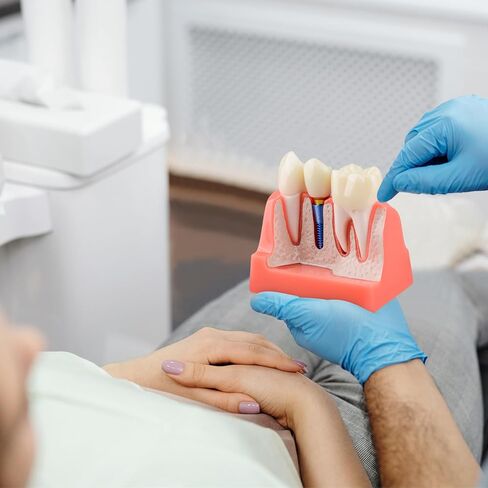 Dental Implant Model for Patient Education, 4 Times Dental Implant, Crown and Bridge Model for Presentation-Transparent in Saudi Arabia