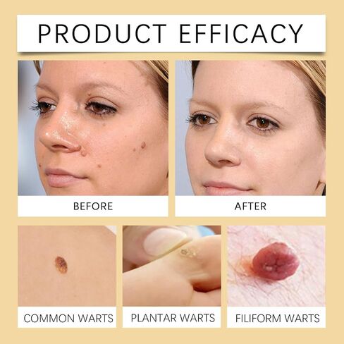 Fast-Acting Bee Venom Wart Cream,Salicylic Acid Wart Remover,Painless and Non-Irritating,Bee Venom Wart Treatment Spray,for All Body Removing and Repair(2pcs) in Saudi Arabia