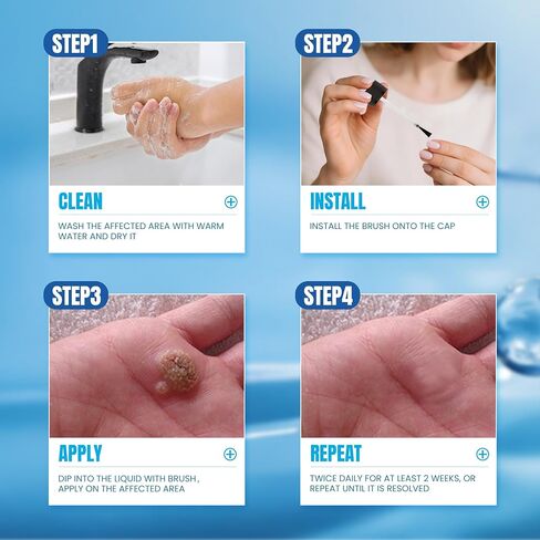 Fast-Acting Wart Corn Remover Freeze Off for Feet, Salicylic Acid Wart Remover for Men Women, Foot Hand Corns Removal for Plantar Genital Common Flat Wart, Callus 1 Oz in Saudi Arabia