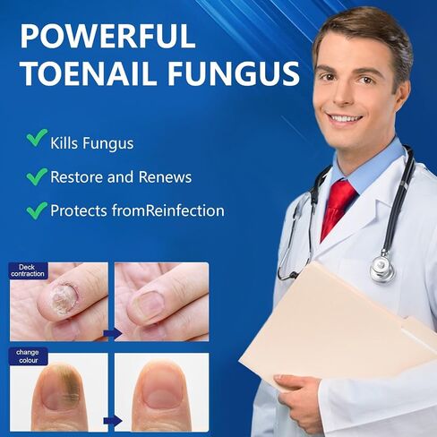 Toenail Fungus Treatment Extra Strength, 30ML Fungus Nail Repair Liquid with 1% Tolnaftate, Fast Acting Treatment for Discolored & Damaged Nails, Athletes Foot in Saudi Arabia