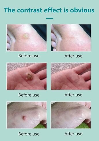 Wart Remover,Skin Tag Remover,17% Salicylic Acid Liquid Wart Remover,Fast-Acting Removal for Men & Women Toes Feet,Freeze Off for Common Calluses,Genital,Flat,Plantar Wart,H Warts,Corn on Toes, 30ML in Saudi Arabia