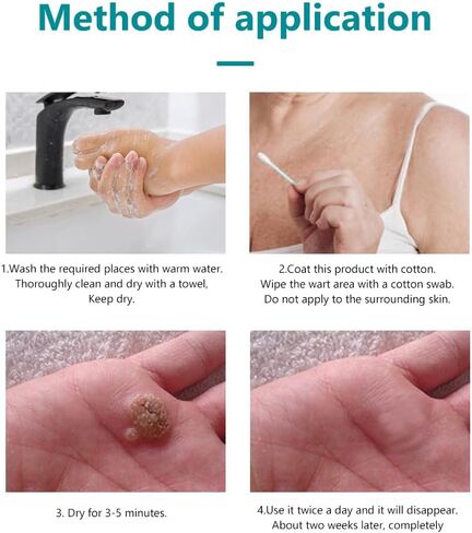 Wart Remover,Skin Tag Remover,17% Salicylic Acid Liquid Wart Remover,Fast-Acting Removal for Men & Women Toes Feet,Freeze Off for Common Calluses,Genital,Flat,Plantar Wart,H Warts,Corn on Toes, 30ML in Saudi Arabia