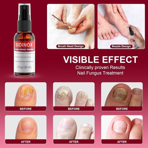 Toenail Fungus Treatment, Treatment Extra Strength with 25% Undecylenic Acid, Fungus Nail Treatment for Damaged Nails, Discolored, Thick Toenails, Help Nail Grow - (1 Fl Oz/30 ml x 5 Pack) in Saudi Arabia