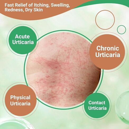 كريمة urticaria لخليط خلايا النحل - يتصرف بسرعة معالجة مضادة لخدوش الجلد ، الاحمرار ، البثور والذمة | صيغة متقدمة in Kuwait