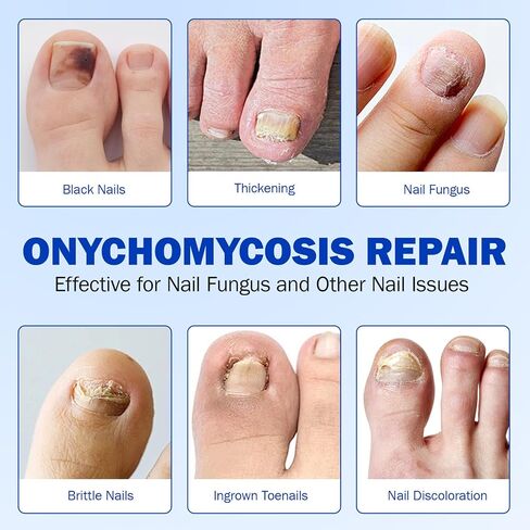 Nail Patches for Toenails, 21pcs/Bag Toenail 8-Hour Overnight Fast Hydrogel Nail Care, Nighttime Nail Repair for Damaged, Discolored Nails, Safe for Sensitive Skin, Easy to Apply (21 PCS) in Kuwait