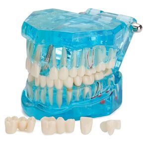 Transparent Dental Implant Teeth Model - Transparent Disease Teeth Model Pathological Tooth Model with Removable Teeth for Dental Study and Education