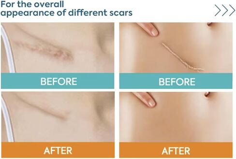 Silicone Scar Sheets 1.6" x 120" - Medical Grade, Long-Lasting, Reusable Tape Roll for C-Section, Surgical Scars, Keloid, Acne, Tummy Tuck Recovery & Wrinkle Treatment in Saudi Arabia