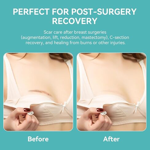 Breast Silicone Scar Sheets – 8 Areola Circles + 4 Anchor Patches | Medical Grade, Reusable & Waterproof Scar Tape for Breast Surgery, Implants, Lift, Reduction & Mastectomy Recovery in Saudi Arabia