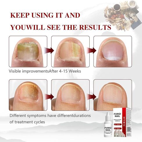 Toenail Fungus Treatment, Herbal Extracts, Nighttime Long-Lasting Nail Treatment, Suitable for Discoloration, Shaped Nails, Thick Nails, Safe and Gentle, Cuticle Care, 15ml/0.5oz (two) in Saudi Arabia