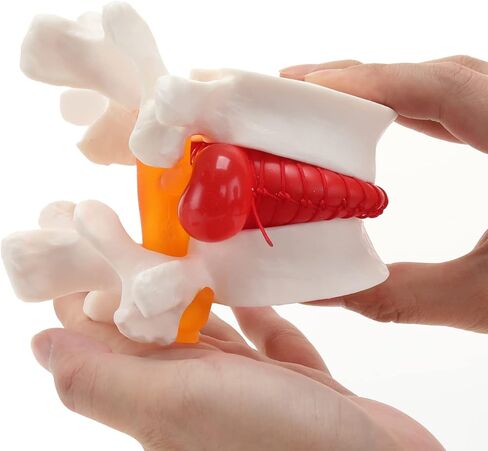 Human Lumbar Disc Herniation Model, Transparent Lumbar Spine Model, with Elastic Software, Press to Simulate Lumbar Disc Herniation in Kuwait