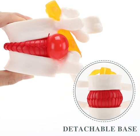 Human Lumbar Disc Herniation Model, Transparent Lumbar Spine Model, with Elastic Software, Press to Simulate Lumbar Disc Herniation in Kuwait