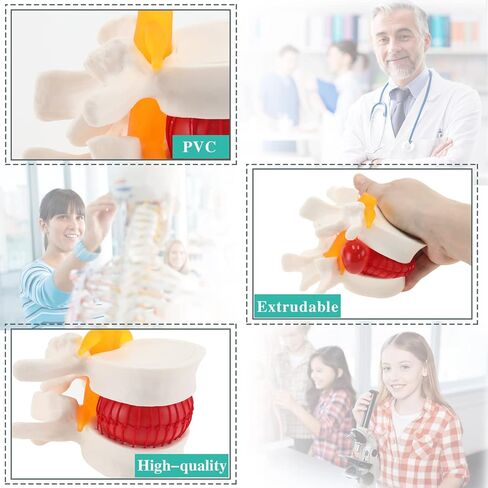 Human Lumbar Disc Herniation Model, Transparent Lumbar Spine Model, with Elastic Software, Press to Simulate Lumbar Disc Herniation in Kuwait