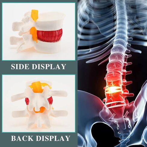 Human Lumbar Disc Herniation Model, Transparent Lumbar Spine Model, with Elastic Software, Press to Simulate Lumbar Disc Herniation in Kuwait