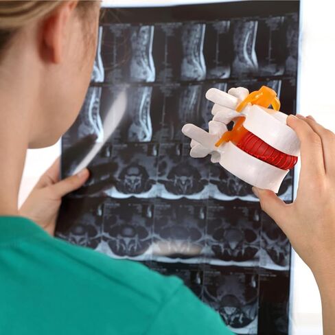 Human Lumbar Disc Herniation Model, Transparent Lumbar Spine Model, with Elastic Software, Press to Simulate Lumbar Disc Herniation in Kuwait