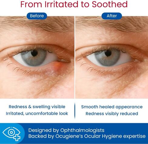 Adhesive Hydrocolloid Patches for Styes & Chalazia: Provide immediate Cosmetic Improvement, Help Absorb Secretions, Reduce Redness, Swelling & Prevent Scarring in Saudi Arabia