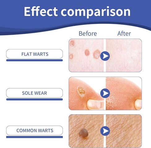 Likluc Fast-Acting Wart Remover Gel with Freeze Off Technology - Genital, Common Warts & Plantar wart Remover for Feet, Skin & More in Kuwait