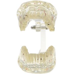 Dental Model Typodont Pathological Tooth Models Caries, Dental Stones, Cysts, Impacted Wisdom Teeth, Implants, Periodontal Disease Display Educational Models M4001