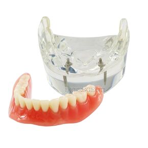 Dental Teeth Model Typodont Implant Restoration M6002 Overdenture 2 Implants Lower Inferior Demo for Study Teach