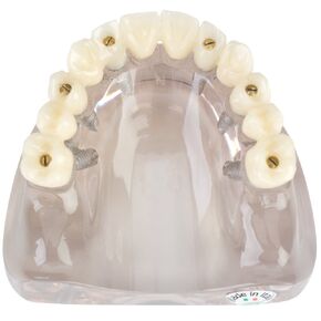 Practicon 4112161 Screw-Retained Full Arch Implant Model