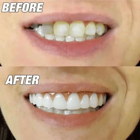 Cosmetic Dental Veneers, Upper and Lower False Teeth Set, Comfortable Fit, Natural Looking Smile in Saudi Arabia