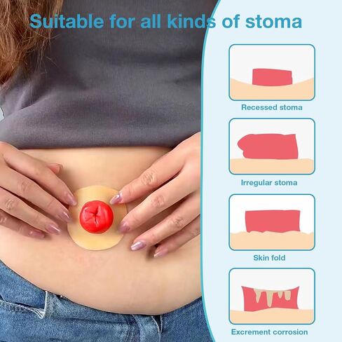 40 PCS Ostomy Barrier Strips, Medical Grade Hydrocolloid, Ostomy Supplies, Elastic Barrier Adhesive Tape for Colostomy Bags, Urostomy Bag, Ileostomy Bag in Saudi Arabia