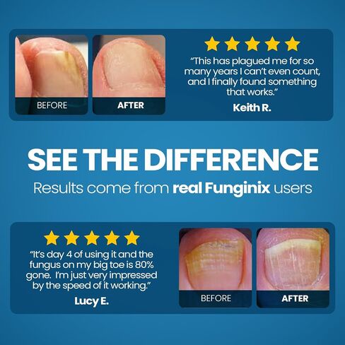 Funginix Toenail Fungus Treatment - أقصى قوة - علاج فطريات الأظافر للأظافر الفطرية - محلول سائل مضاد للفطريات - مصنوع في زجاجة الولايات المتحدة الأمريكية - (قد تختلف التغليف) in Kuwait