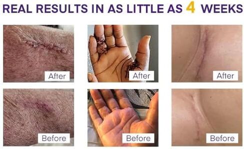 Silicone Scar Sheets for Surgical Scars: Silicone Gel Sheets for Keloids, Burns, Abrasion and C-Section - Safe for Adults and Children - Breathable, Skin-Friendly and Waterproof Silicone Tape 4PCS in Kuwait