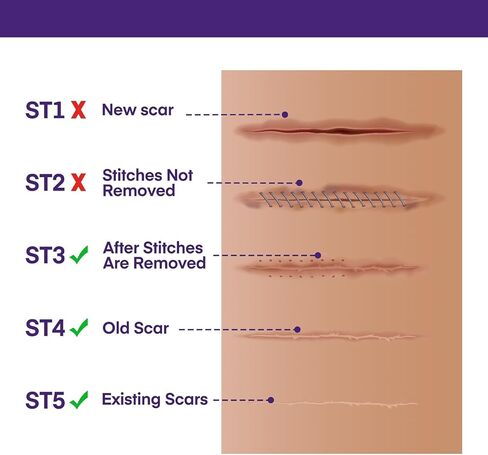Silicone Scar Sheets for Surgical Scars: Silicone Gel Sheets for Keloids, Burns, Abrasion and C-Section - Safe for Adults and Children - Breathable, Skin-Friendly and Waterproof Silicone Tape 4PCS in Kuwait