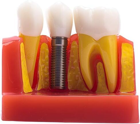 EASYTODENTA 4 مرات زرع نموذج لشكل الأسنان تحليل الأسنان جسر التاج مظاهرة نموذج لشكل الأسنان للتعليم والتواصل مع المرضى in Kuwait